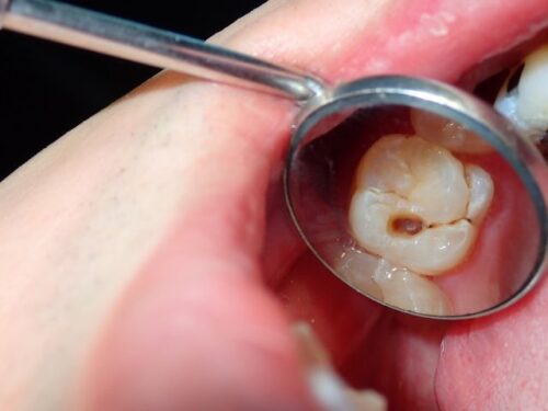 虫歯を歯医者で治療する夢占い